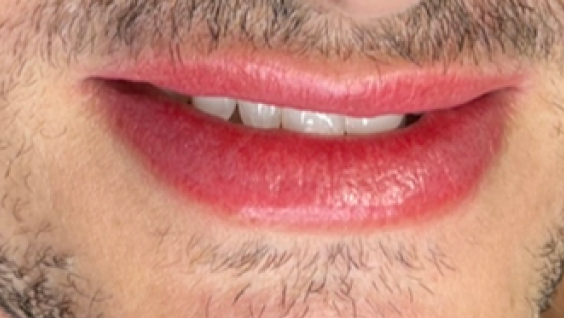 Resultado 4